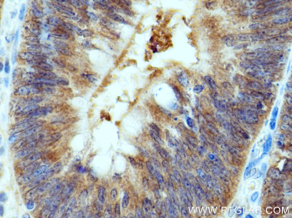Immunohistochemistry (IHC) staining of human colon cancer tissue using SAC3D1 Polyclonal antibody (25857-1-AP)