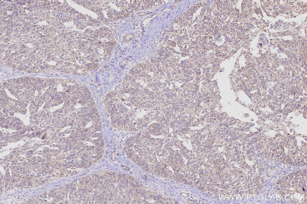 Immunohistochemistry (IHC) staining of human ovary cancer tissue using SAC3D1 Polyclonal antibody (25857-1-AP)