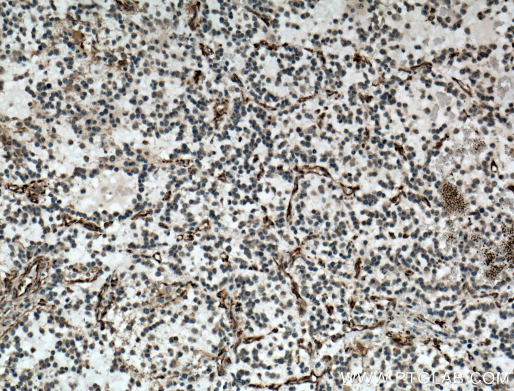 Immunohistochemistry (IHC) staining of human gliomas tissue using SACS Polyclonal antibody (22265-1-AP)