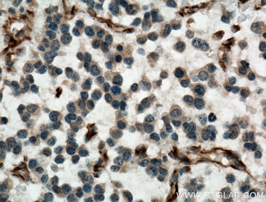 IHC staining of human gliomas using 22265-1-AP