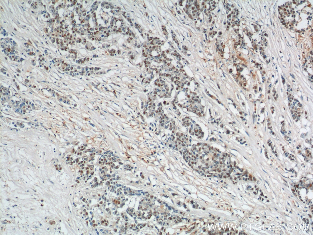 Immunohistochemistry (IHC) staining of human colon cancer tissue using SAE1 Polyclonal antibody (10229-1-AP)