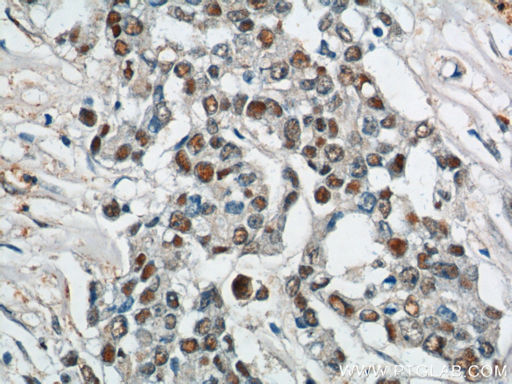Immunohistochemistry (IHC) staining of human colon cancer tissue using SAE1 Polyclonal antibody (10229-1-AP)