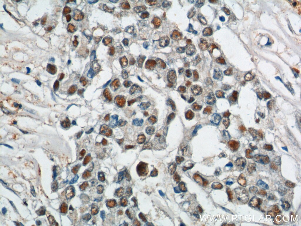 Immunohistochemistry (IHC) staining of human colon cancer tissue using SAE1 Polyclonal antibody (10229-1-AP)