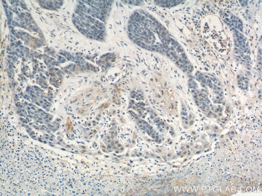 Immunohistochemistry (IHC) staining of human skin cancer tissue using SAE1 Polyclonal antibody (10229-1-AP)