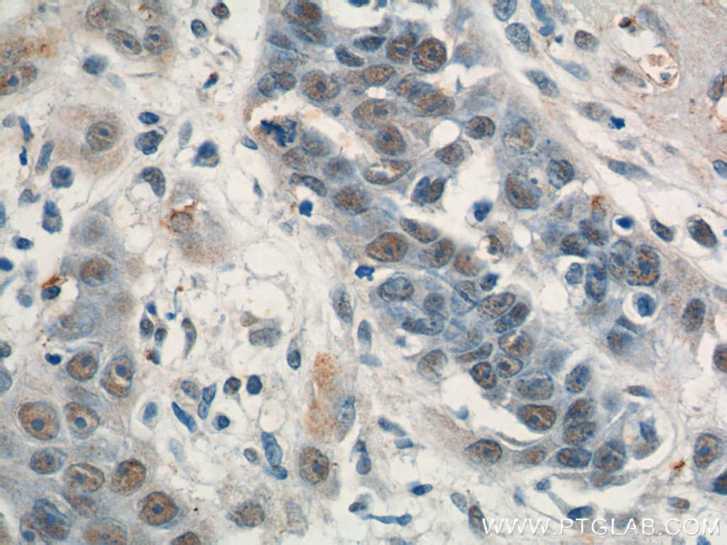 Immunohistochemistry (IHC) staining of human skin cancer tissue using SAE1 Polyclonal antibody (10229-1-AP)