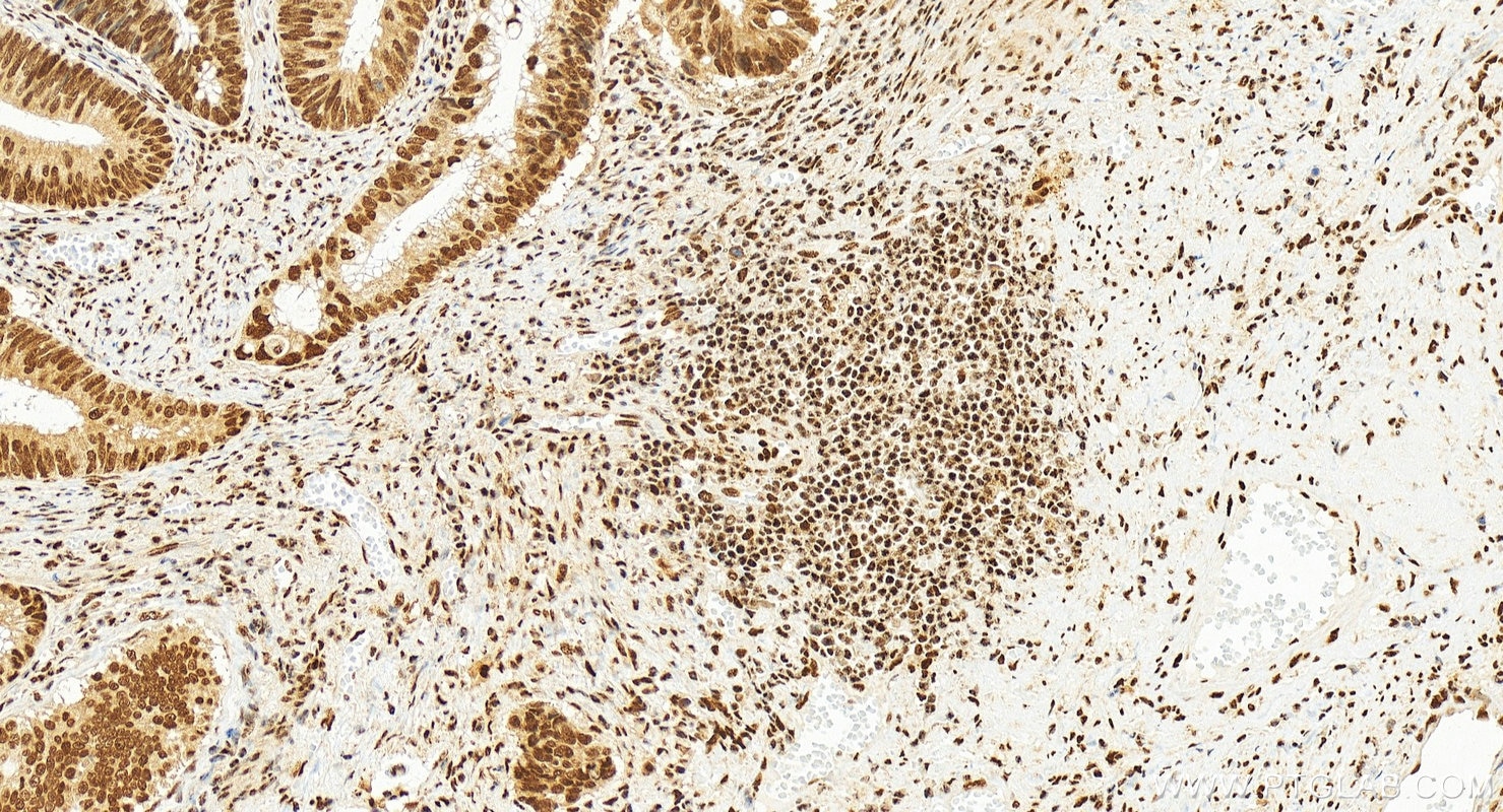 Immunohistochemistry (IHC) staining of human colon cancer tissue using SAE1 Recombinant antibody (84516-6-RR)