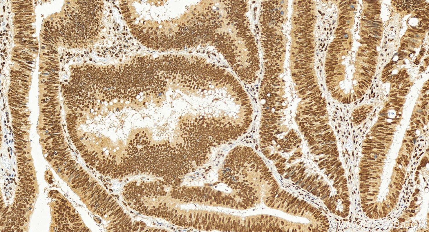 Immunohistochemistry (IHC) staining of human colon cancer tissue using SAE1 Recombinant antibody (84516-6-RR)