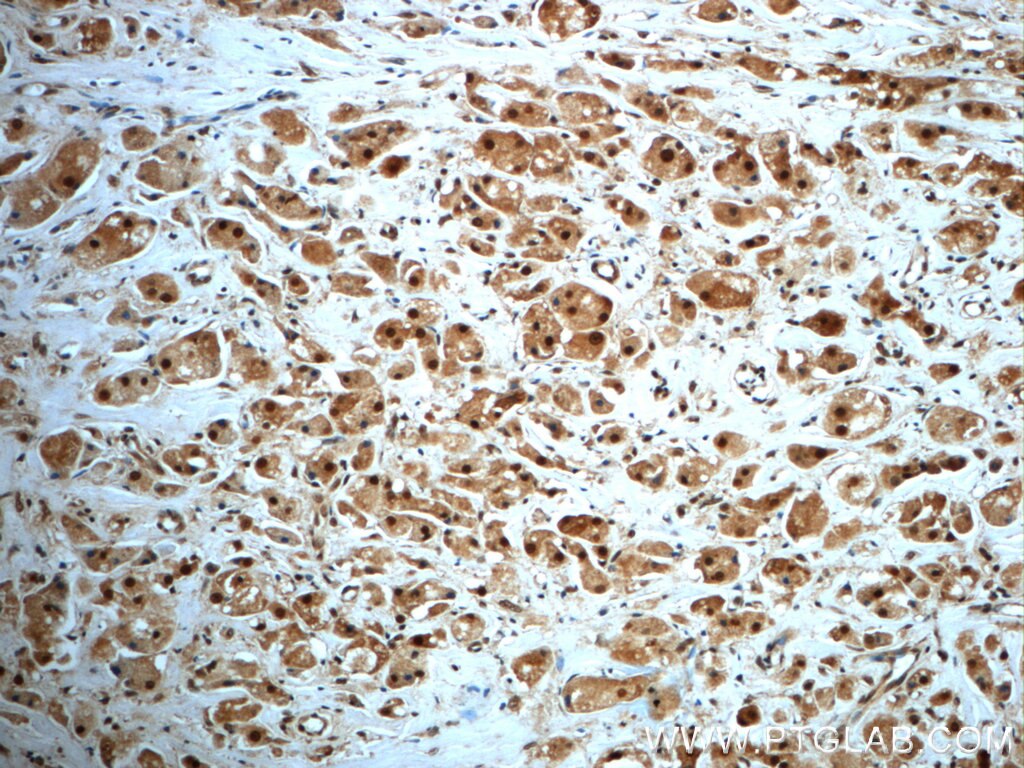 Immunohistochemistry (IHC) staining of human breast cancer tissue using SAFB Polyclonal antibody (21857-1-AP)