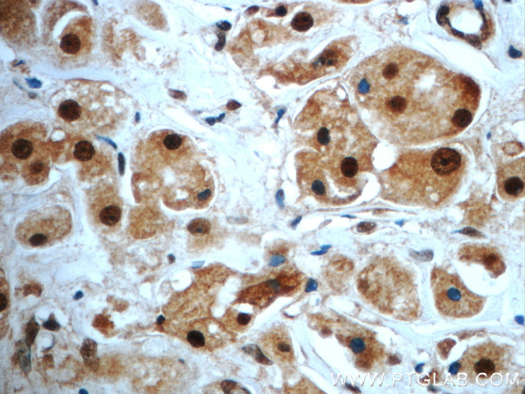 Immunohistochemistry (IHC) staining of human breast cancer tissue using SAFB Polyclonal antibody (21857-1-AP)