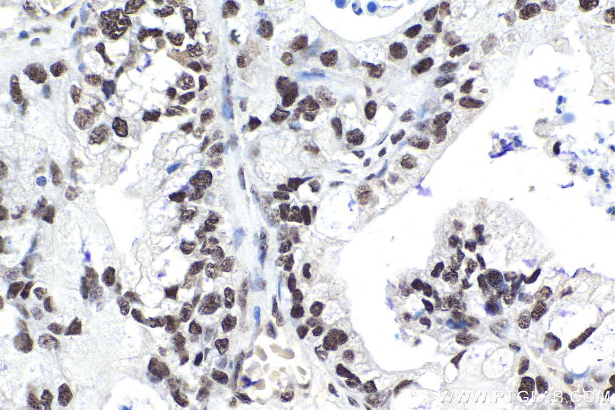 Immunohistochemistry (IHC) staining of human pancreas cancer tissue using SAFB2 Polyclonal antibody (11642-1-AP)