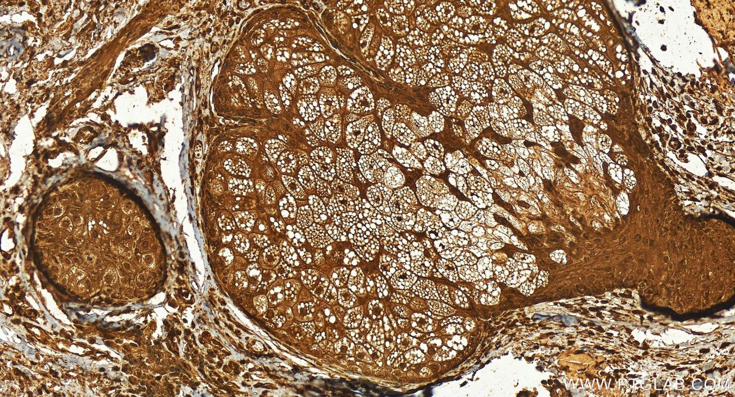 Immunohistochemistry (IHC) staining of human skin cancer tissue using SAGE1 Polyclonal antibody (30914-1-AP)