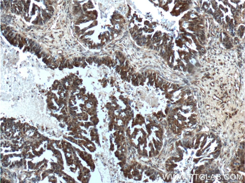 Immunohistochemistry (IHC) staining of human ovary tumor tissue using SALL4 Polyclonal antibody (24500-1-AP)