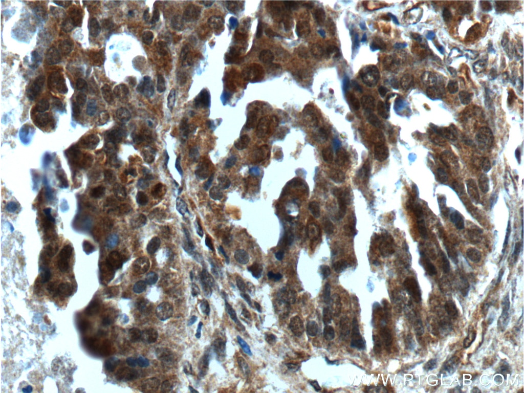 Immunohistochemistry (IHC) staining of human ovary tumor tissue using SALL4 Polyclonal antibody (24500-1-AP)