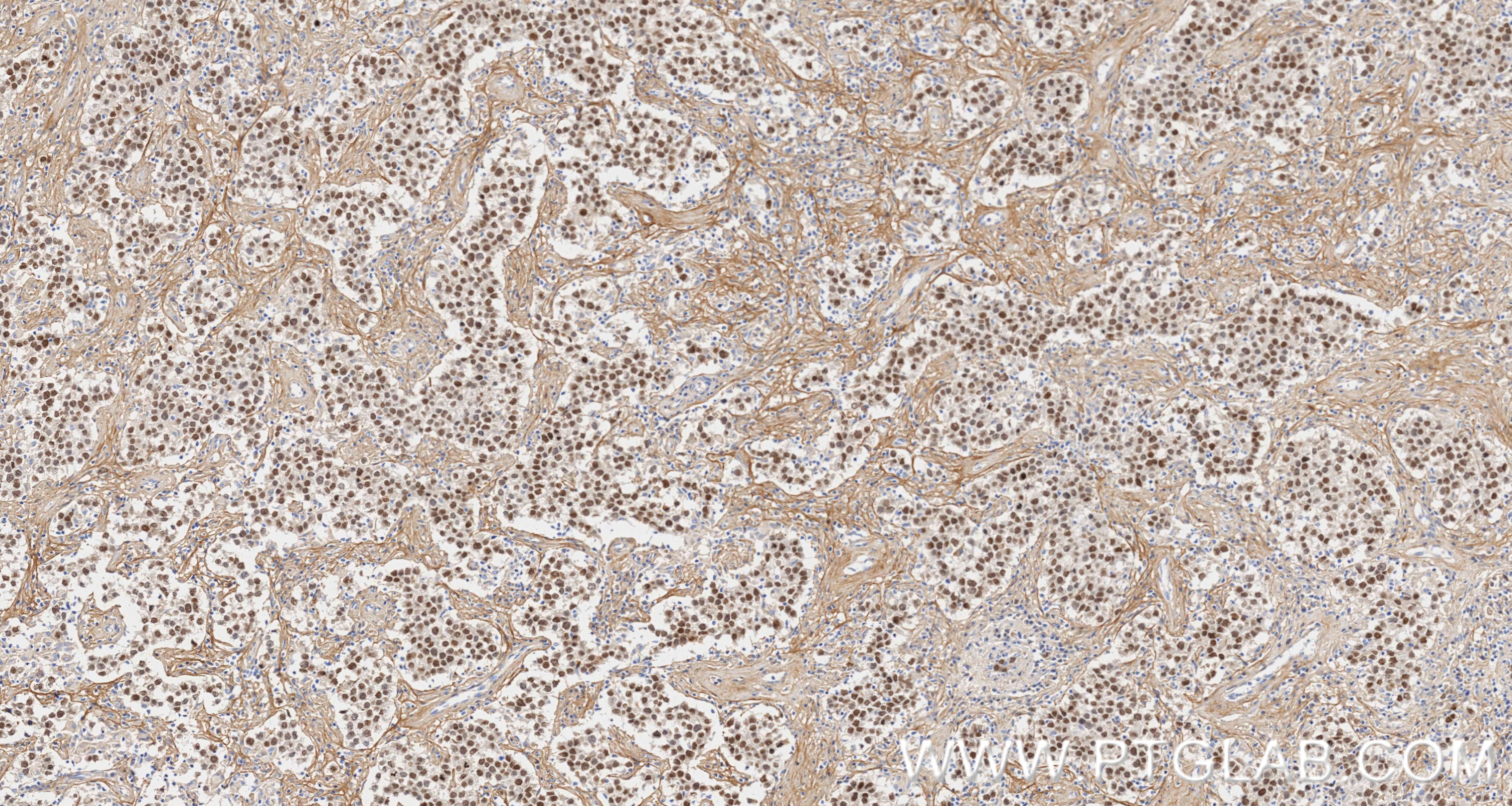 Immunohistochemical analysis of paraffin-embedded Human seminoma slide using 83039-4-RR (SALL4 antibody) at dilution of 1:2000 (under 10x lens). Heat mediated antigen retrieval with Tris-EDTA buffer (pH 9.0). This data was developed using the same antibody clone with 83039-4-PBS in a different storage buffer formulation. Immunohistochemistry (IHC) staining of Human seminoma using SALL4 Recombinant monoclonal antibody (83039-4-RR)