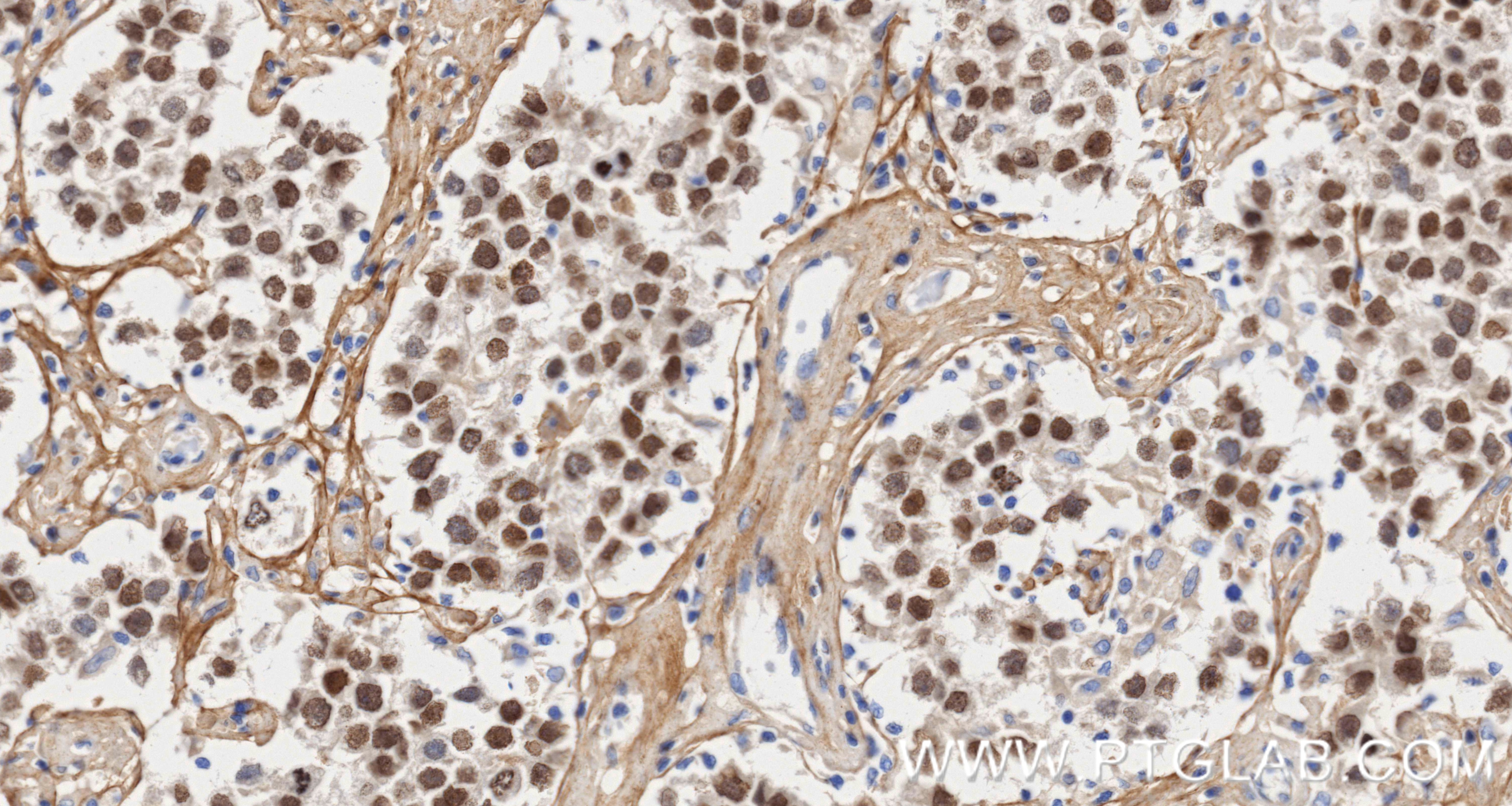 Immunohistochemical analysis of paraffin-embedded Human seminoma slide using 83039-4-RR (SALL4 antibody) at dilution of 1:2000 (under 40x lens). Heat mediated antigen retrieval with Tris-EDTA buffer (pH 9.0). This data was developed using the same antibody clone with 83039-4-PBS in a different storage buffer formulation. Immunohistochemistry (IHC) staining of Human seminoma using SALL4 Recombinant monoclonal antibody (83039-4-RR)