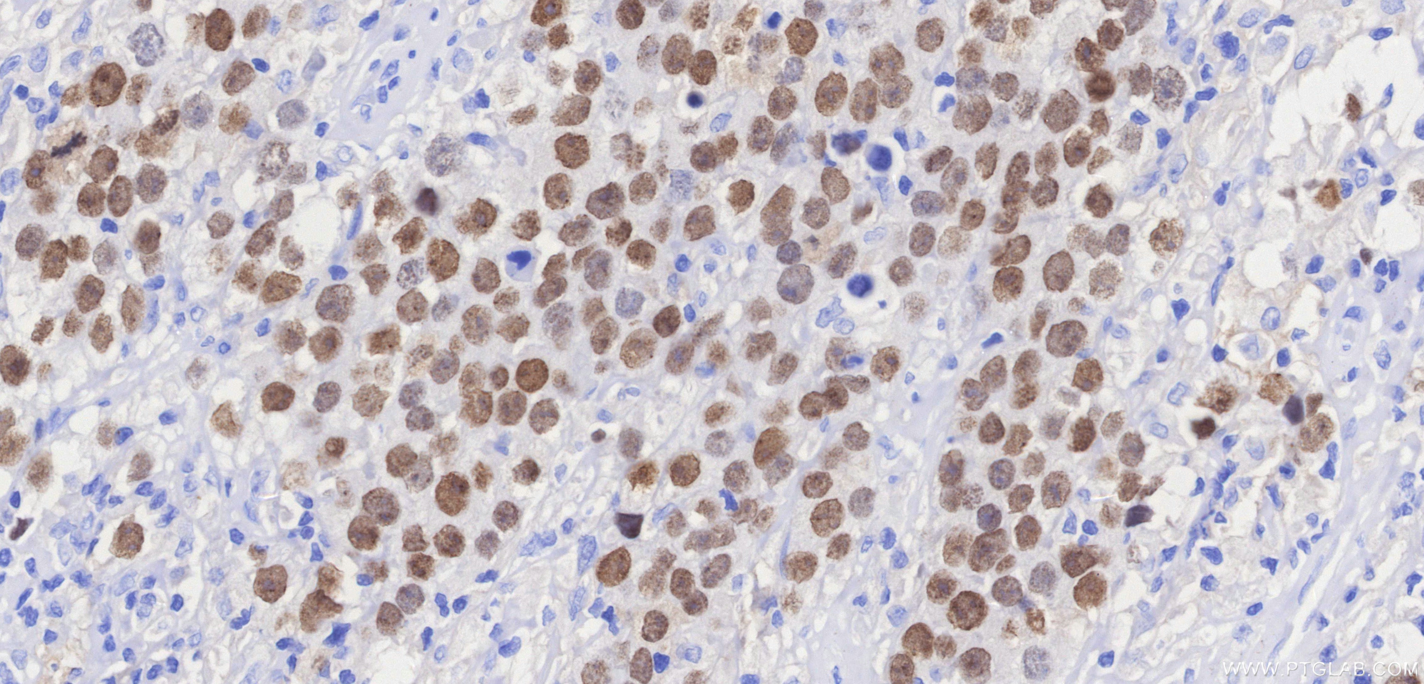 Immunohistochemistry (IHC) staining of Human seminoma tissue using SALL4 Recombinant monoclonal antibody (83039-7-RR)