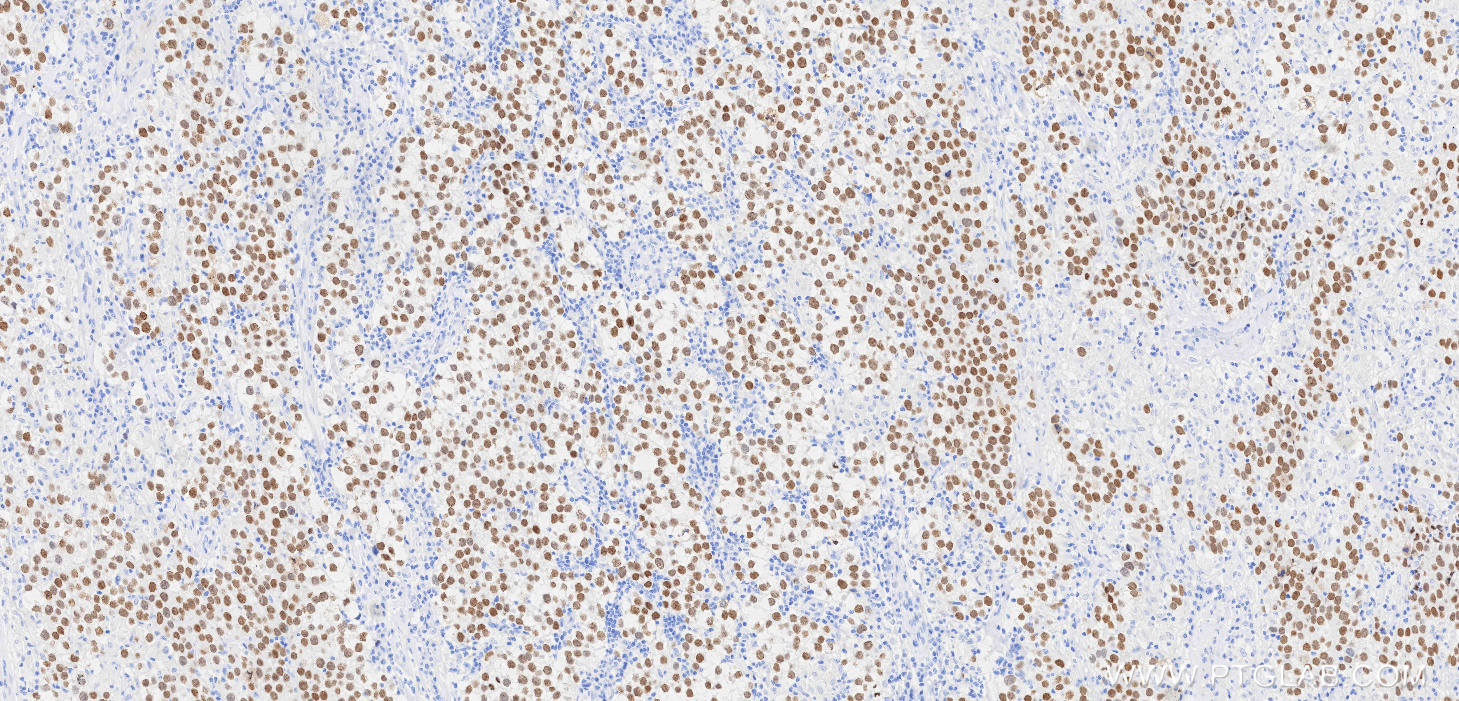 IHC staining of human seminoma using 83039-8-RR Immunohistochemistry (IHC) staining of human seminoma tissue using SALL4 Recombinant monoclonal antibody (83039-8-RR)