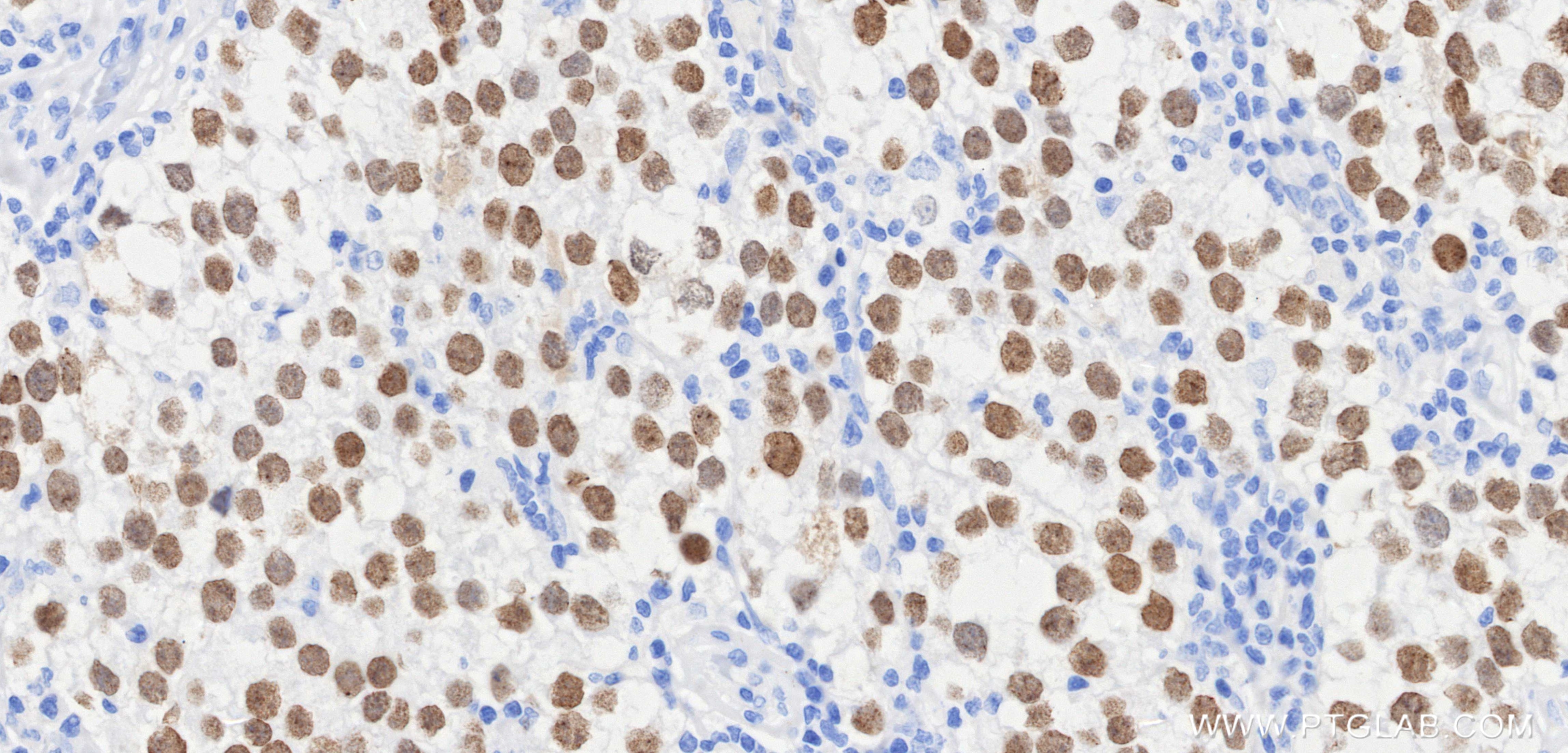 IHC staining of human seminoma using 83039-8-RR Immunohistochemistry (IHC) staining of human seminoma tissue using SALL4 Recombinant monoclonal antibody (83039-8-RR)