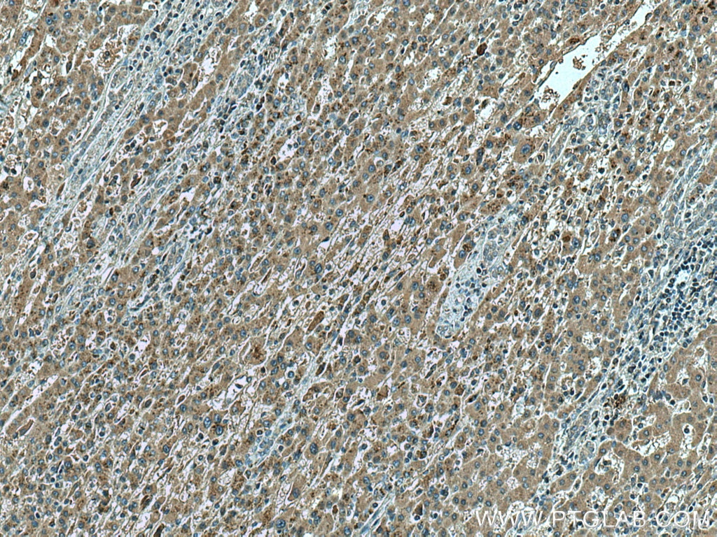 IHC staining of human liver cancer using 67425-1-Ig