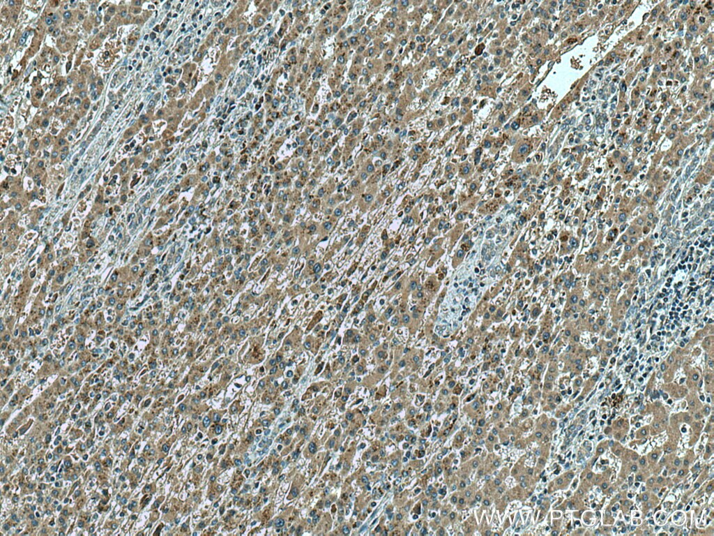 Immunohistochemistry (IHC) staining of human liver cancer tissue using Sam50 Monoclonal antibody (67425-1-Ig)