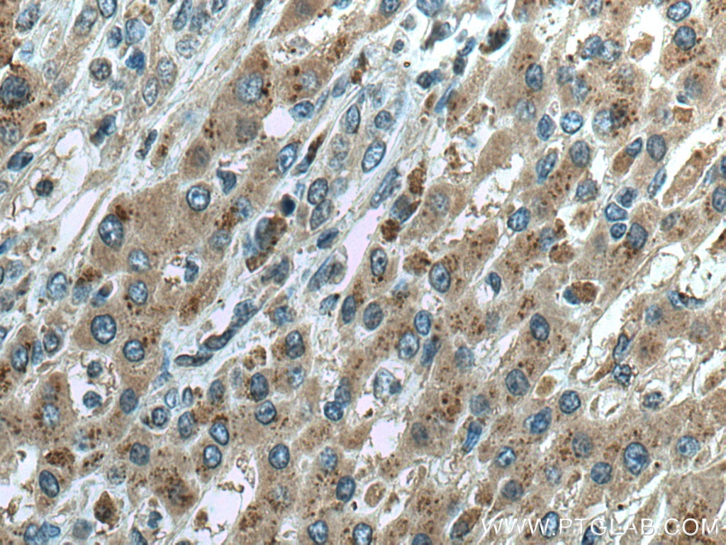 Immunohistochemistry (IHC) staining of human liver cancer tissue using Sam50 Monoclonal antibody (67425-1-Ig)