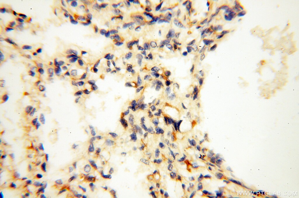 Immunohistochemistry (IHC) staining of human lung tissue using SAMD4A Polyclonal antibody (17387-1-AP)