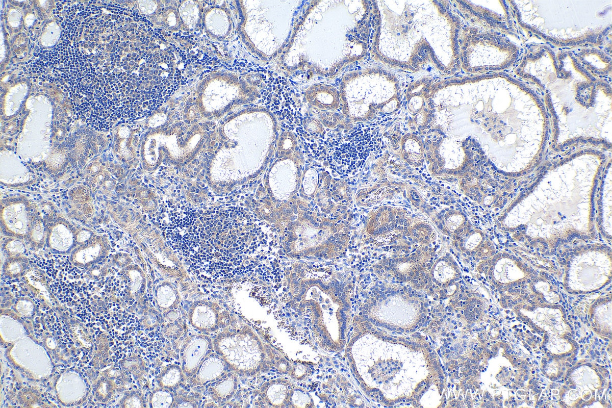 Immunohistochemistry (IHC) staining of human thyroid cancer tissue using SAMD4B Polyclonal antibody (17723-1-AP)