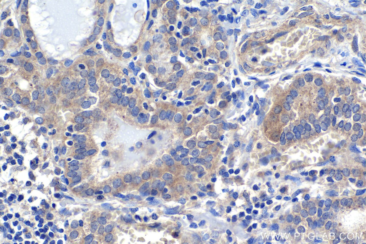Immunohistochemistry (IHC) staining of human thyroid cancer tissue using SAMD4B Polyclonal antibody (17723-1-AP)