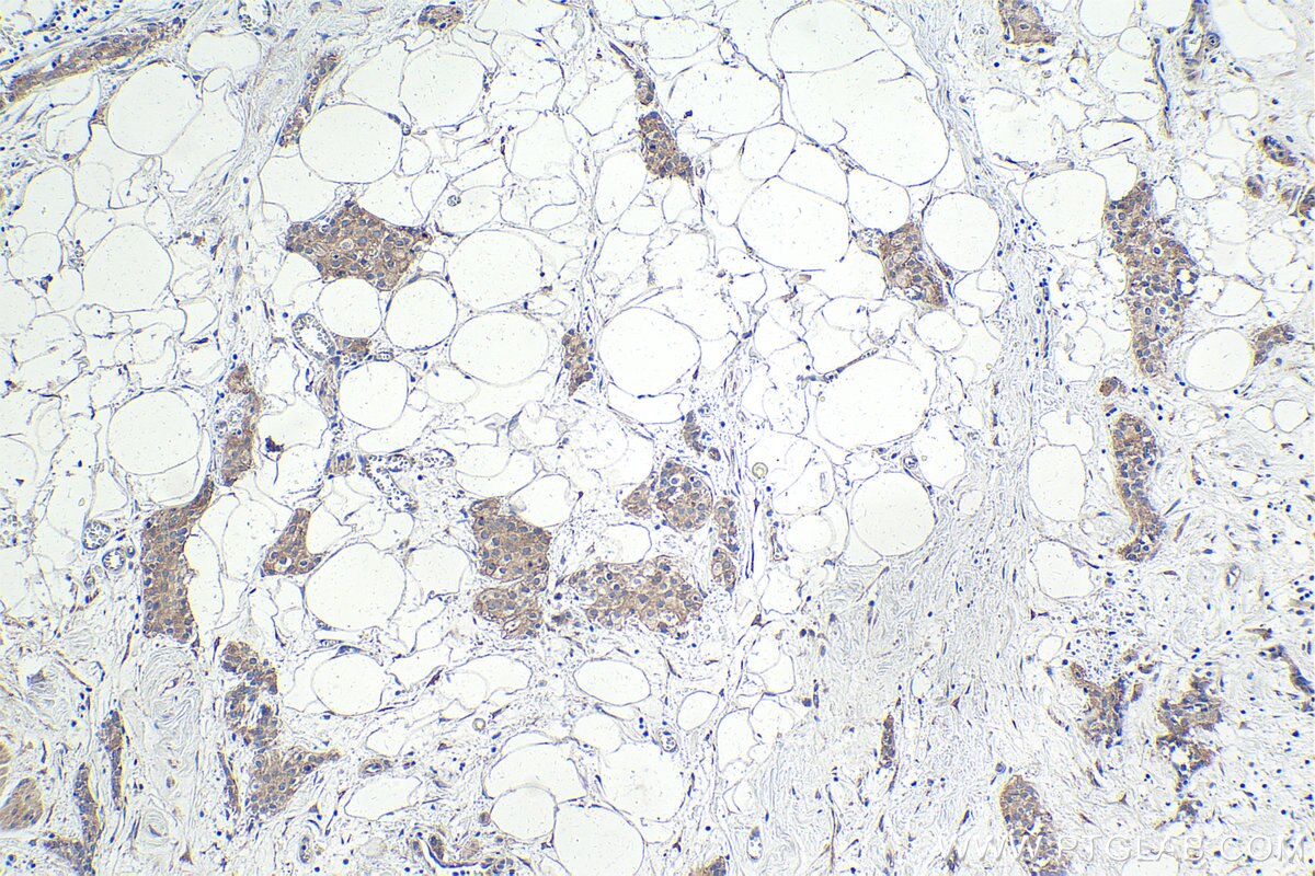 Immunohistochemistry (IHC) staining of human urothelial carcinoma tissue using SAMD4B Polyclonal antibody (17723-1-AP)