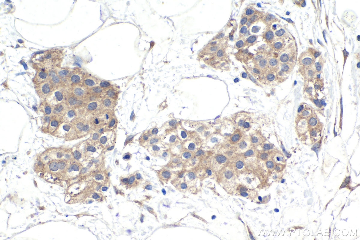 Immunohistochemistry (IHC) staining of human urothelial carcinoma tissue using SAMD4B Polyclonal antibody (17723-1-AP)