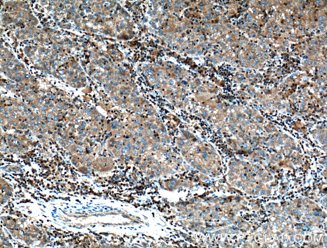 Immunohistochemistry (IHC) staining of human liver cancer tissue using SAMD8 Polyclonal antibody (26815-1-AP)