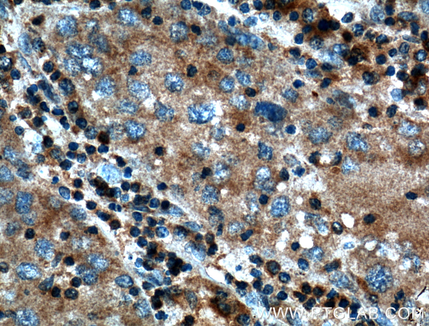 Immunohistochemistry (IHC) staining of human liver cancer tissue using SAMD8 Polyclonal antibody (26815-1-AP)
