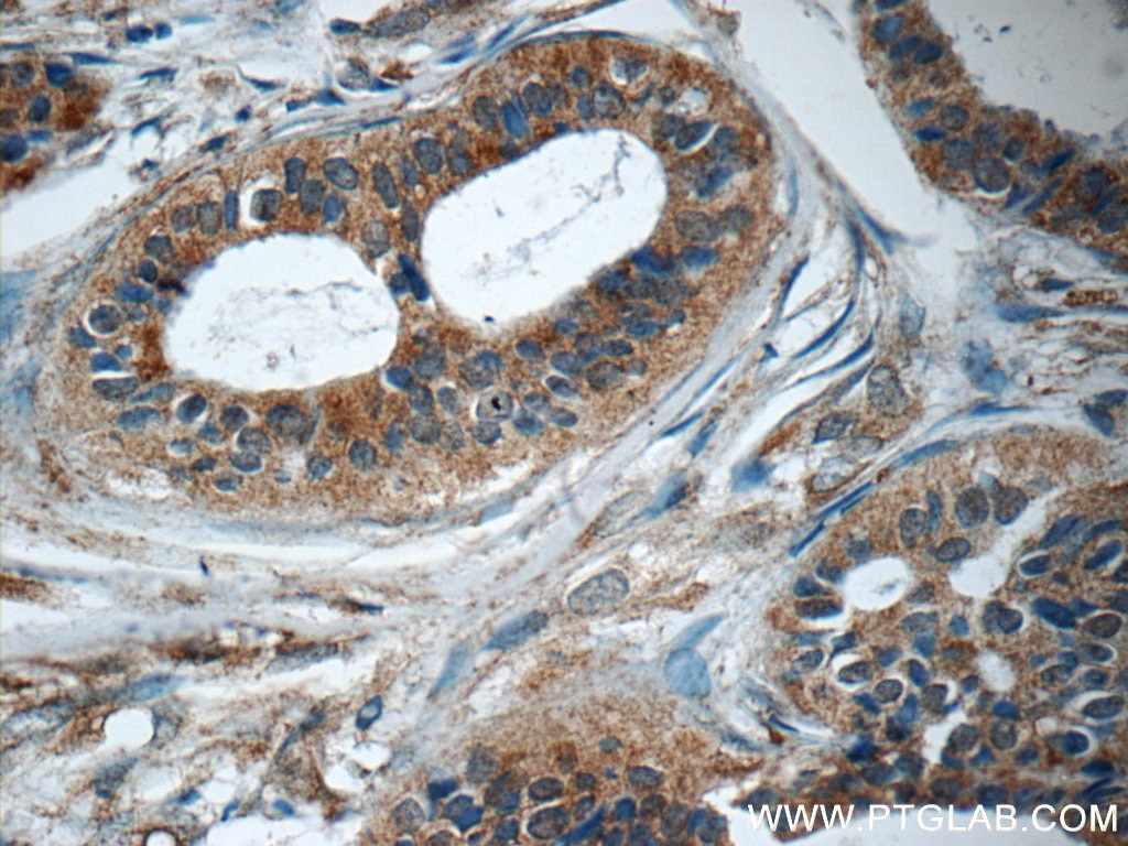 Immunohistochemistry (IHC) staining of human breast cancer tissue using SAMD9L Polyclonal antibody (25173-1-AP)