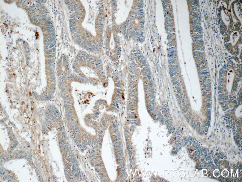 Immunohistochemistry (IHC) staining of human colon cancer tissue using SAMD9L Polyclonal antibody (25173-1-AP)