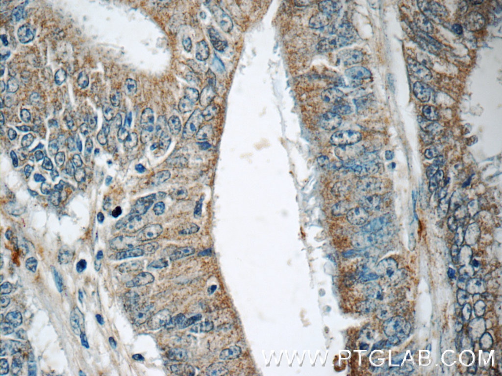Immunohistochemistry (IHC) staining of human colon cancer tissue using SAMD9L Polyclonal antibody (25173-1-AP)