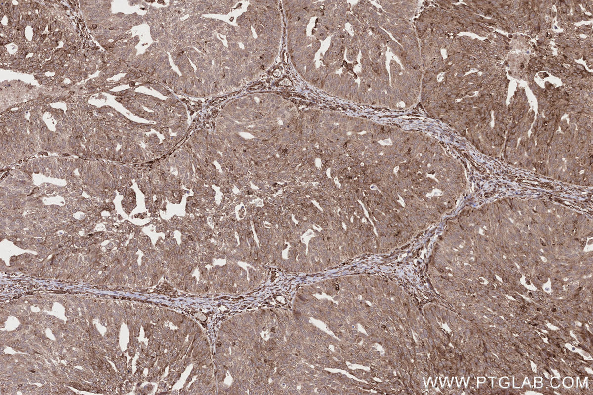 Immunohistochemistry (IHC) staining of human ovary cancer tissue using SAMD9L Polyclonal antibody (25173-1-AP)