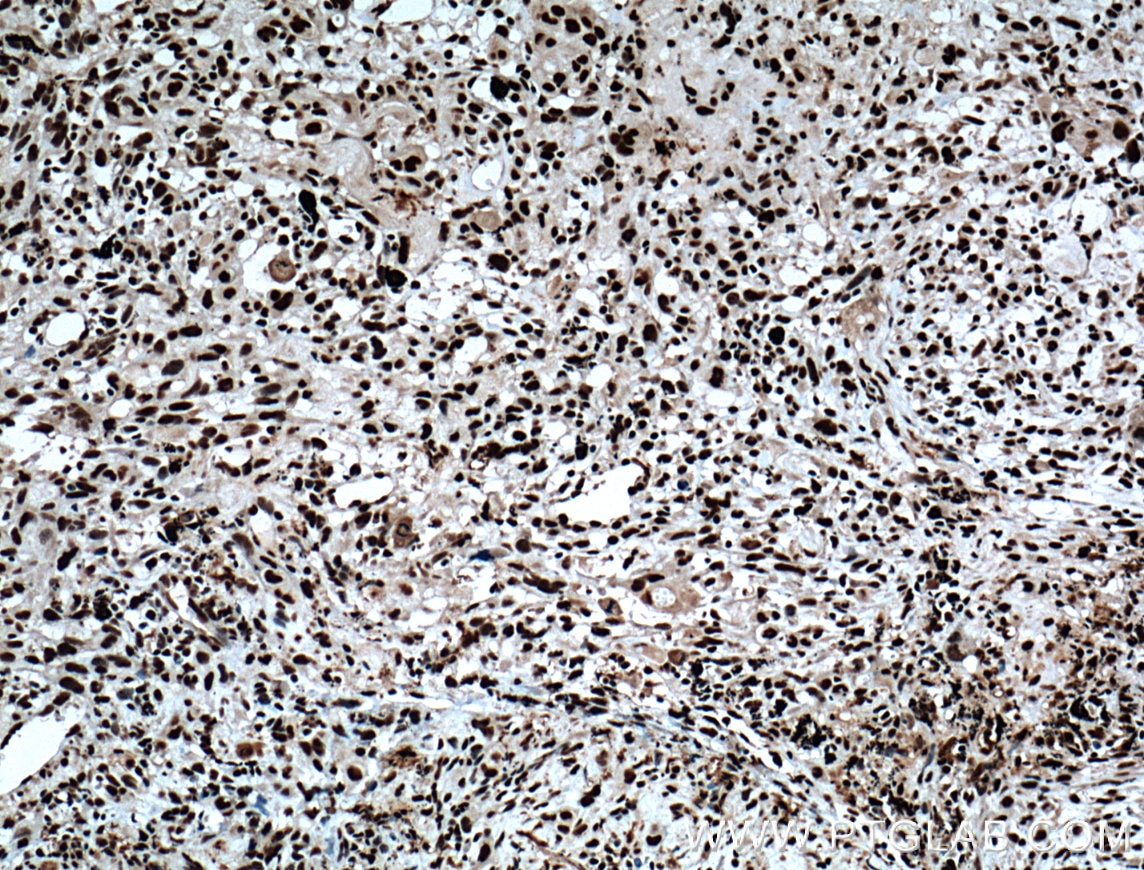 IHC staining of human lung cancer using 12586-1-AP