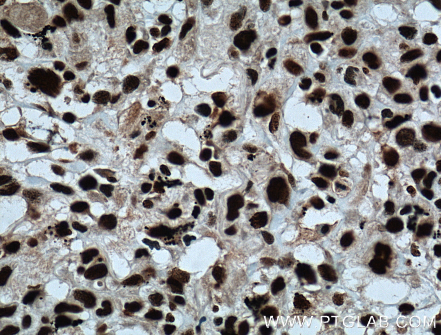 Immunohistochemistry (IHC) staining of human lung cancer tissue using SAMHD1 Polyclonal antibody (12586-1-AP)