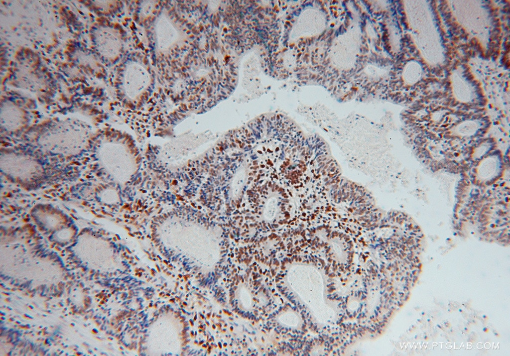 Immunohistochemistry (IHC) staining of human colon cancer tissue using SAMHD1 Polyclonal antibody (12586-1-AP)