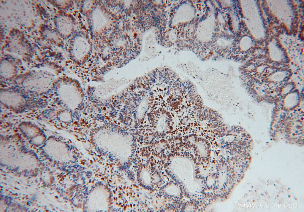 IHC staining of human colon cancer using 12586-1-AP