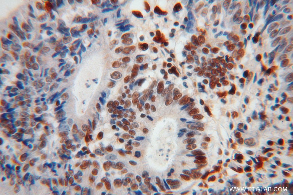 IHC staining of human colon cancer using 12586-1-AP