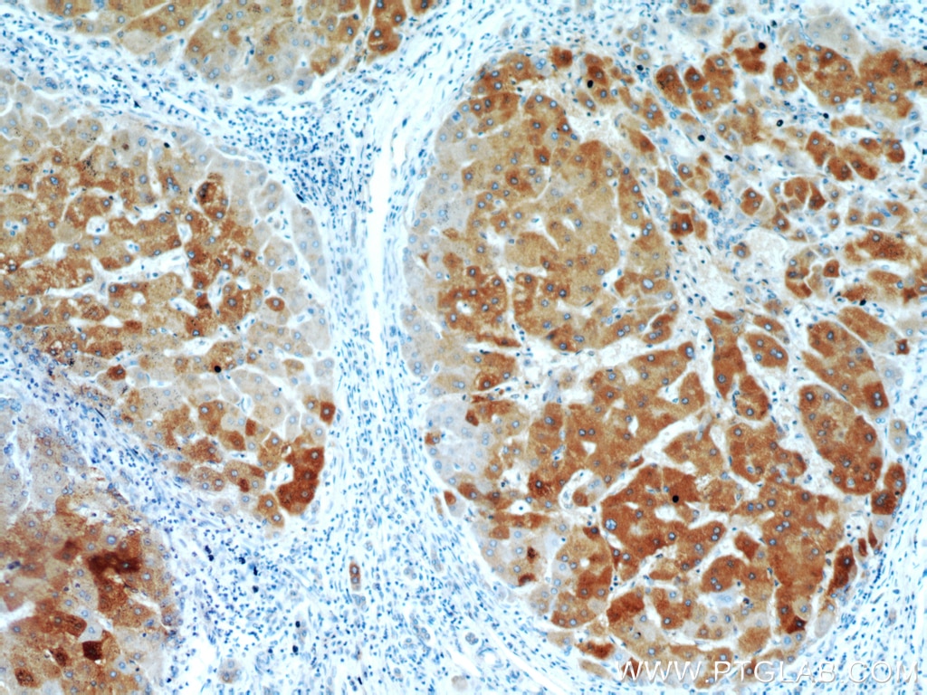 IHC staining of human hepatocirrhosis using 20824-1-AP