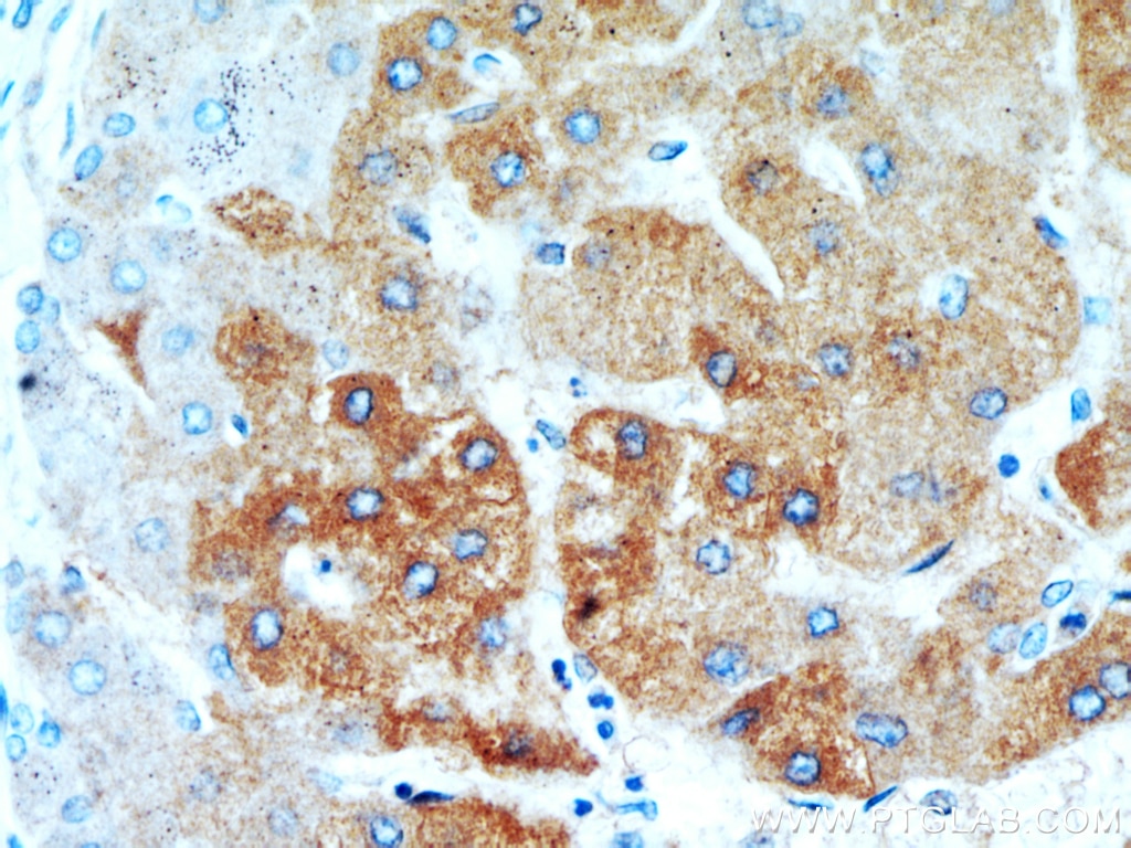 Immunohistochemistry (IHC) staining of human hepatocirrhosis tissue using Sam50 Polyclonal antibody (20824-1-AP)
