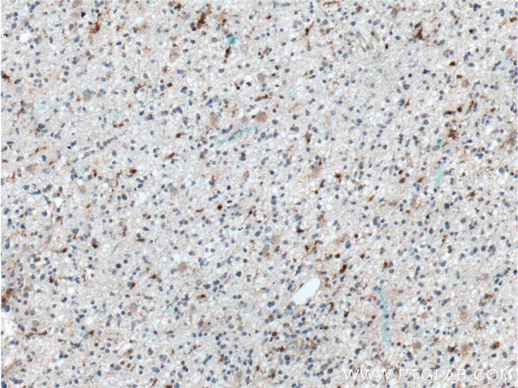 Immunohistochemistry (IHC) staining of human gliomas tissue using SAMSN1 Polyclonal antibody (13063-1-AP)