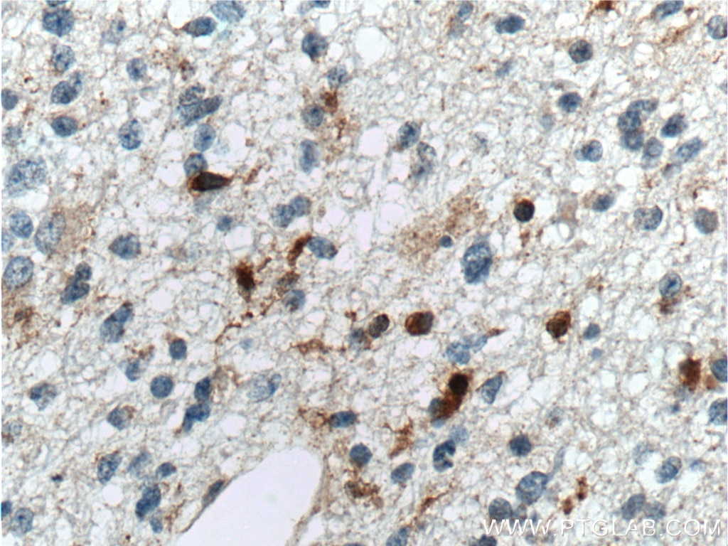 Immunohistochemistry (IHC) staining of human gliomas tissue using SAMSN1 Polyclonal antibody (13063-1-AP)