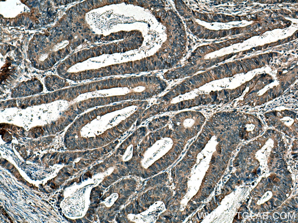 Immunohistochemistry (IHC) staining of human colon cancer tissue using SAP 97 Polyclonal antibody (29292-1-AP)