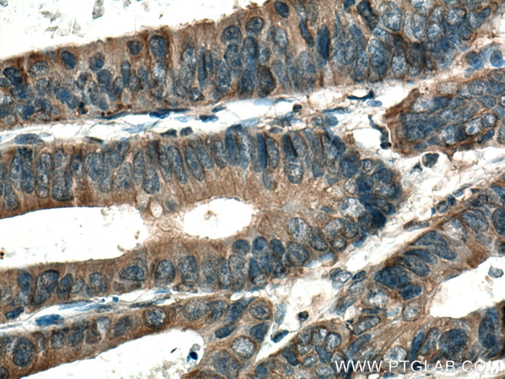 IHC staining of human colon cancer using 29292-1-AP