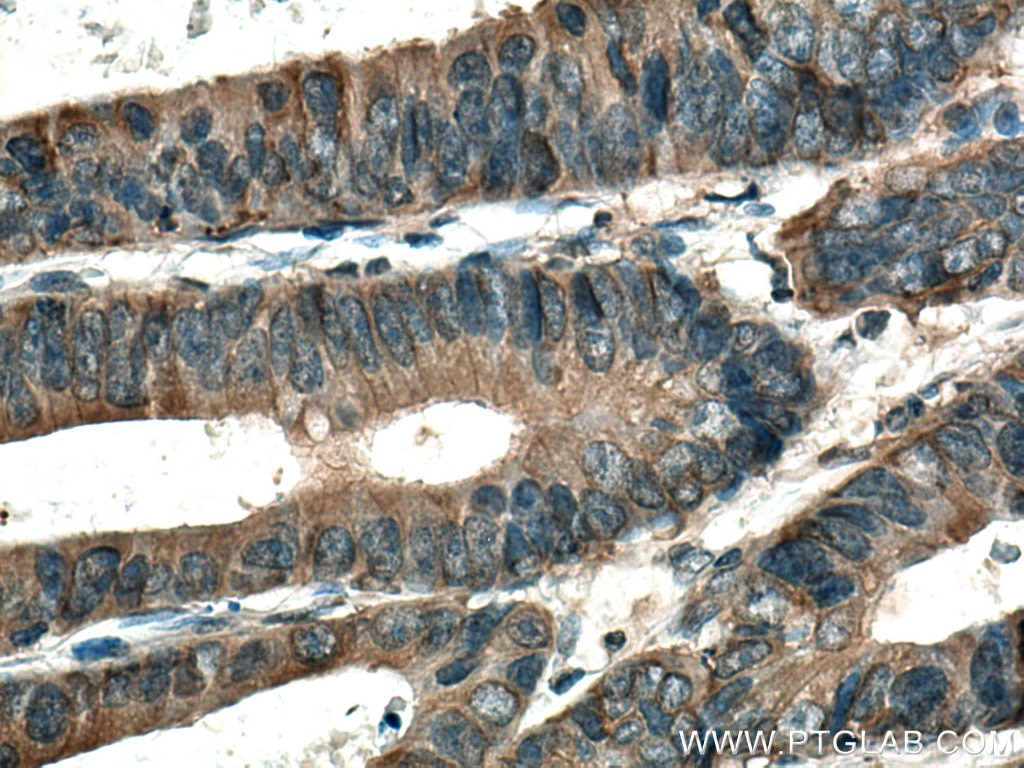 Immunohistochemistry (IHC) staining of human colon cancer tissue using SAP 97 Polyclonal antibody (29292-1-AP)