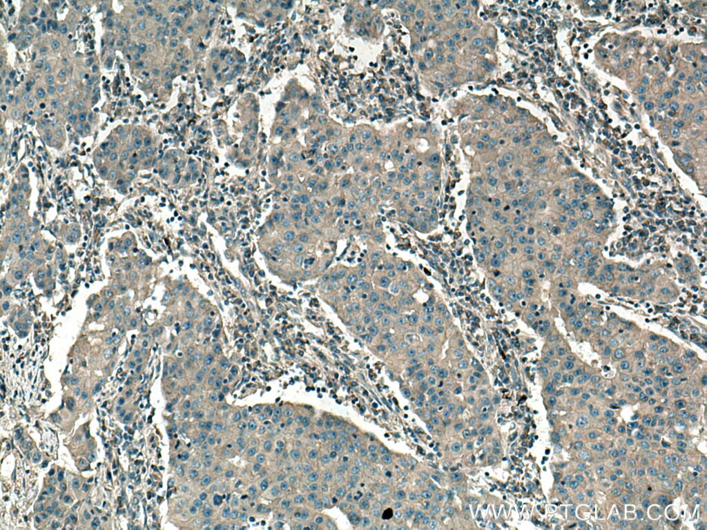 Immunohistochemistry (IHC) staining of human breast cancer tissue using SAP 97 Polyclonal antibody (29292-1-AP)