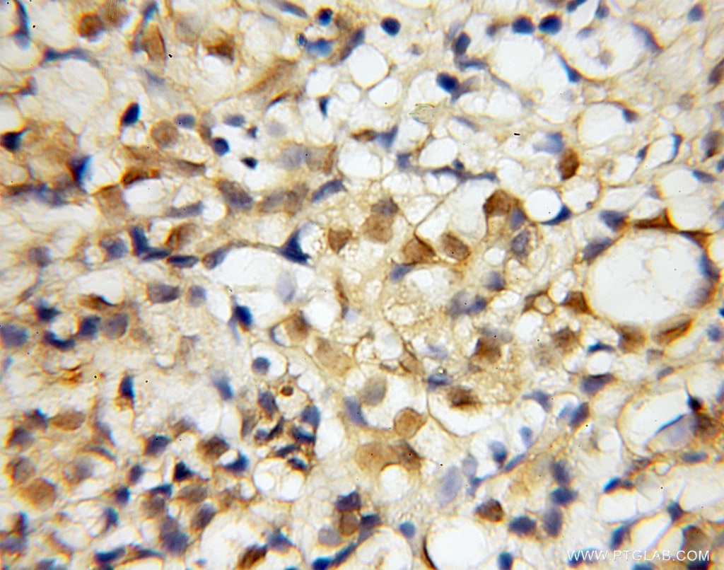 Immunohistochemistry (IHC) staining of human pancreas cancer tissue using SAP130 Polyclonal antibody (12130-1-AP)